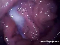 De ontsteking in de vagina